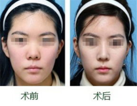 如何做大鼻子整形,大鼻子整形的多样途径与技巧解析