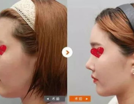 鼻部综合整形,鼻部综合整形的全面解析与优势