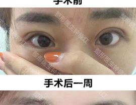 最好的双眼皮整形医院,美丽蜕变从这里开始”