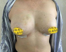 自体脂肪隆胸整形手术价格,影响因素与费用概览