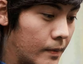卸掉滤镜后白鹿满口獠牙忍了孙楠变孙姨忍了真人卤蛋没忍住，男生重要部位长痘痘会怎么样