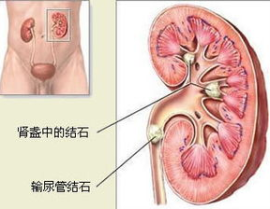 肾结石的食疗方法,天然排石，健康生活新选择